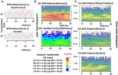 How Eye Movements Stabilize Posture in Patients With Bilateral Vestibular Hypofunction